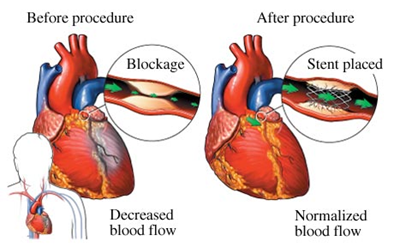 Effect of Stent Placement in Increasing Blood FlowCourtesy of Lakeview Center